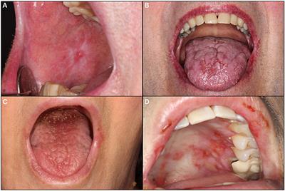 Immune checkpoint inhibitors in cancer therapy: Review of orofacial adverse events and role of the oral healthcare provider